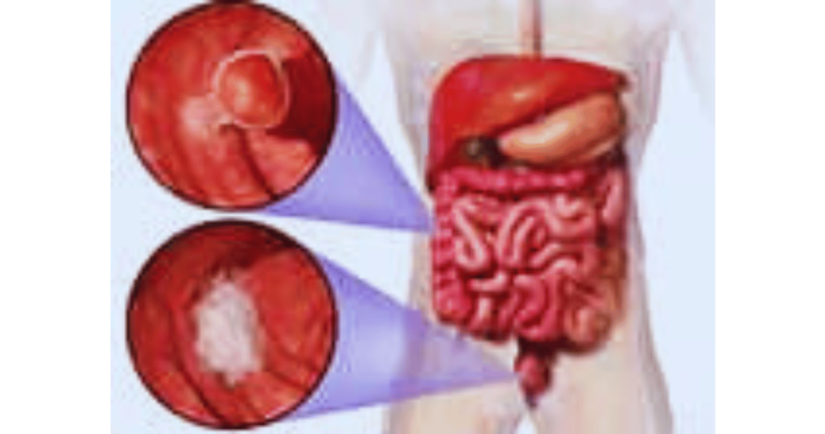 colorectal cancer spots in the stomach