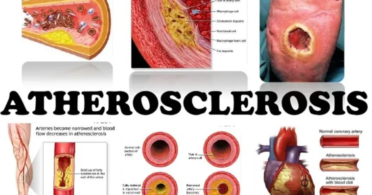 Reversing Atherosclerosis Naturally: A Plant-Based Approach