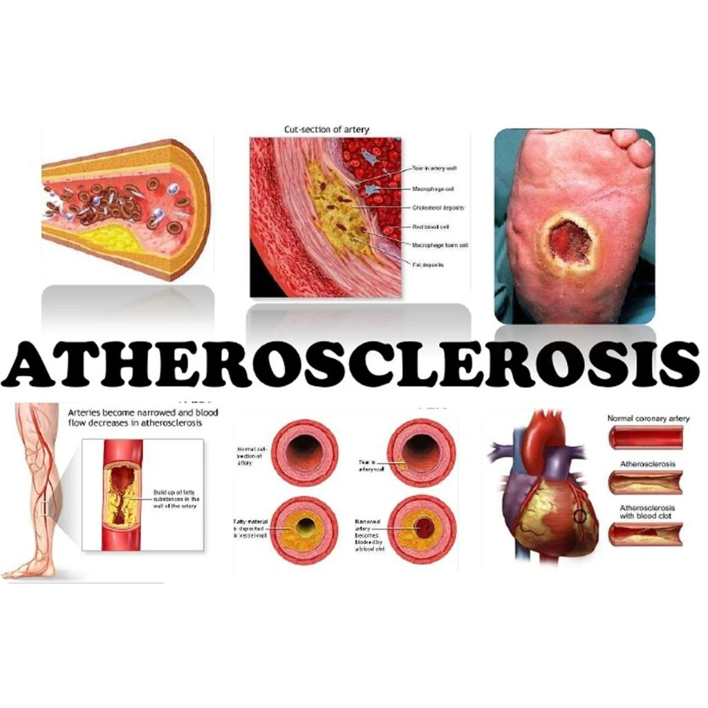Reversing Atherosclerosis Naturally: A Plant-Based Approach